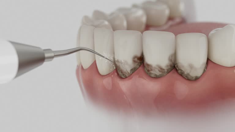 Trusted Wisdom Tooth Removal service in West Pensacola, FL - Dentist Open Now